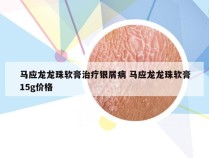 马应龙龙珠软膏治疗银屑病 马应龙龙珠软膏15g价格