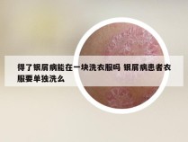 得了银屑病能在一块洗衣服吗 银屑病患者衣服要单独洗么