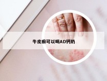 牛皮癣可以喝AD钙奶