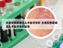 点滴型银屑病怎么才能尽快好 点滴型银屑病怎么才能尽快好起来