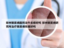 郑州银屑病医院治牛皮癣好吗 郑州银屑病研究所治疗银屑病效果好吗