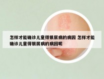 怎样才能确诊儿童得银屑病的病因 怎样才能确诊儿童得银屑病的病因呢