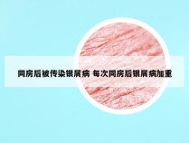 同房后被传染银屑病 每次同房后银屑病加重