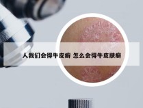 人我们会得牛皮癣 怎么会得牛皮肤癣