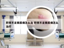 肝阴不足银屑病怎么治 肝阴不足银屑病怎么治疗