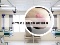 治疗牛皮廯 治疗牛皮治疗哪里好
