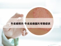 牛皮癣照片 牛皮皮癣图片早期症状