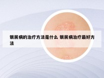 银屑病的治疗方法是什么 银屑病治疗最好方法