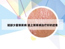 腿部少量银屑病 腿上银屑病治疗好的迹象