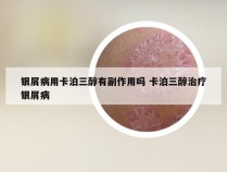 银屑病用卡泊三醇有副作用吗 卡泊三醇治疗银屑病
