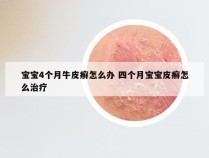 宝宝4个月牛皮癣怎么办 四个月宝宝皮癣怎么治疗