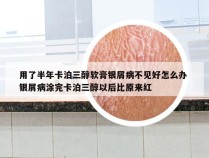 用了半年卡泊三醇软膏银屑病不见好怎么办 银屑病涂完卡泊三醇以后比原来红
