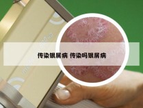 传染银屑病 传染吗银屑病