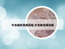 牛皮癣的发展历程 牛皮癣发展周期