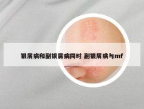 银屑病和副银屑病同时 副银屑病与mf