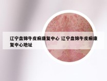 辽宁盘锦牛皮癣康复中心 辽宁盘锦牛皮癣康复中心地址