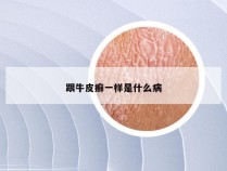 跟牛皮癣一样是什么病