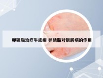 卵磷脂治疗牛皮癣 卵磷脂对银屑病的作用