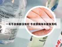 一年牛皮癣都没有好 牛皮肤癣每年都复发吗