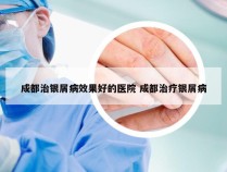 成都治银屑病效果好的医院 成都治疗银屑病