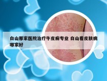 白山那家医院治疗牛皮癣专业 白山看皮肤病哪家好