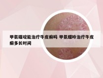 甲氨碟啶能治疗牛皮癣吗 甲氨蝶呤治疗牛皮癣多长时间