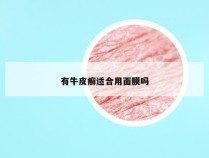 有牛皮癣适合用面膜吗