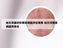 哈尔滨最好的银屑病医院在哪里 哈尔滨银屑病医院排名
