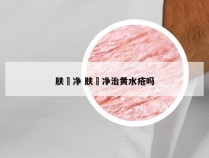 肤廯净 肤廯净治黄水疮吗