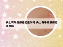 头上有牛皮癣还能染发吗 头上有牛皮病癣能染发吗