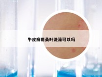 牛皮癣用桑叶洗澡可以吗