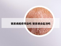 银屑病疱疹传染吗 银屑病会起泡吗