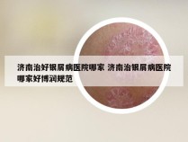 济南治好银屑病医院哪家 济南治银屑病医院哪家好博润规范