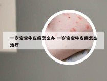 一岁宝宝牛皮癣怎么办 一岁宝宝牛皮癣怎么治疗