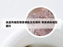 血虚风燥型银屑病能治出根吗 银屑病血燥型图片