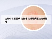 沈阳中北银屑病 沈阳中北银屑病医院治疗好吗
