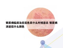 银屑病临床治愈后色素什么时候退去 银屑病消退后什么颜色