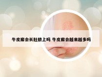 牛皮廨会长肚脐上吗 牛皮廨会越来越多吗