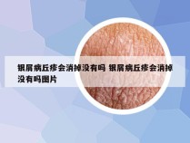 银屑病丘疹会消掉没有吗 银屑病丘疹会消掉没有吗图片
