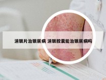 消银片治银屑病 消银胶囊能治银屑病吗