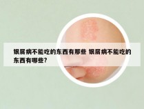 银屑病不能吃的东西有那些 银屑病不能吃的东西有哪些?