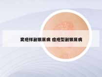 窦疮样副银屑病 痘疮型副银屑病
