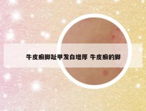 牛皮癣脚趾甲发白增厚 牛皮癣的脚