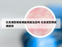 红皮病型银屑病能彻底治愈吗 红皮症型银屑病症状