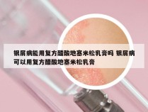 银屑病能用复方醋酸地塞米松乳膏吗 银屑病可以用复方醋酸地塞米松乳膏