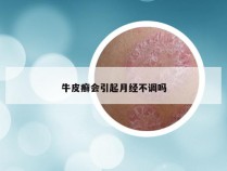 牛皮癣会引起月经不调吗