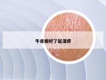 牛皮癣好了起湿疹