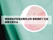 银屑病治疗好后还要忌口吗 银屑病好了之后需要注意什么
