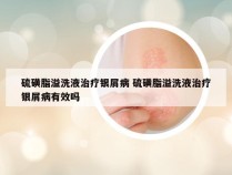 硫磺脂溢洗液治疗银屑病 硫磺脂溢洗液治疗银屑病有效吗