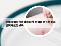 副银屑病有色素减退斑吗 副银屑病有色素减退斑吗能治好吗